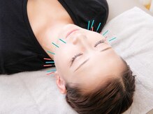 ネイビー鍼灸指圧治療院(NAVY鍼灸指圧治療院)/美容鍼