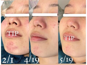 22クラレ(22curare)/肌改善・肌管理☆集中プログラム