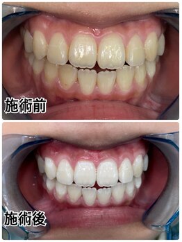 ホワイトニングビューティー 名古屋栄店(WHITENING BEAUTY)/セルフホワイトニング
