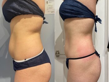 エイシスグロウ(asis glow.)/効果写真