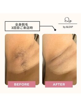 キュオバイアンドリープ(Qo by &LEAP)/全身脱毛ビフォーアフター☆
