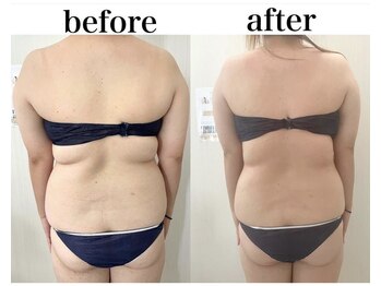 ミセル(MISEL2nd)/キープ力◎リピートNo.1最新痩身