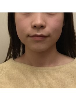 プリンセス バイ セイフティプリンセス 長野店(PRINCESS)/劇的！小顔矯正～After～