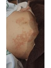 ハリス(HARIS)/皮膚　腹部　発症直後