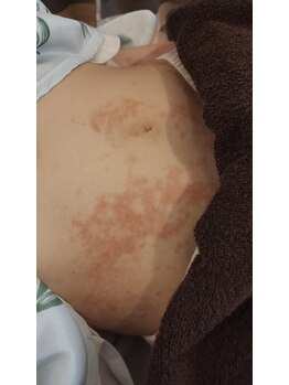 ハリス(HARIS)/皮膚　腹部　発症直後