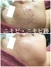 【ニキビケア】プラズマフォト＋REVIハーブピーリング¥11000