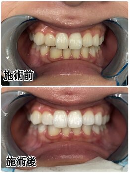 ホワイトニングビューティー 名古屋栄店(WHITENING BEAUTY)/セルフホワイトニング