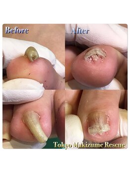 巻き爪補正店 松戸店/巻き爪補正