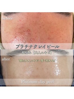 シルビー(CILBE)/プラチナクレイピール