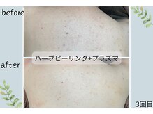 ウェルビー(Well-Be)/ハーブピーリング＋プラズマ導入