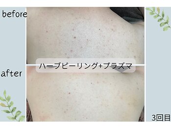 ウェルビー(Well-Be)/ハーブピーリング＋プラズマ導入
