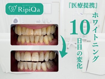 リピカ(RipiQa)/施術例