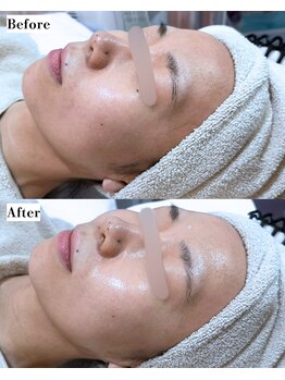 ソワナ(soina)/【神楽坂駅/フェイシャル/毛穴】