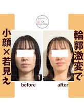 美顔デザインsuu.～若見えと歪み矯正専門の小顔サロン～/Before-After【40代】8回