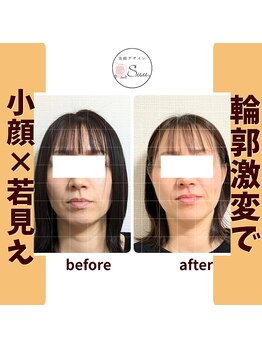 美顔デザインsuu.~若見えと歪み矯正専門の小顔サロン~/Before-After【40代】8回