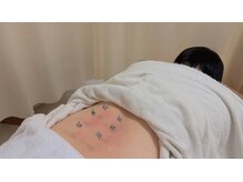 一期一縁 愛媛松山店/灸頭鍼　燃焼後