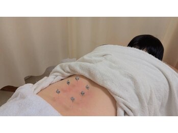 一期一縁 愛媛松山店/灸頭鍼　燃焼後