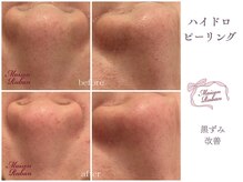 メゾンリュバン 梅田店(Maison Ruban)/毛穴洗浄｜毛穴ケア