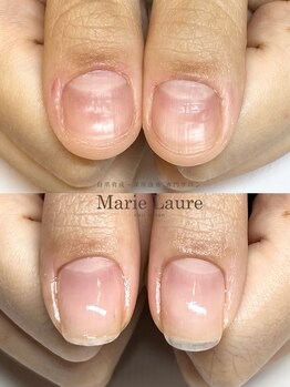 マリーロール 梅田店(Marie Laure)/自爪育成/深爪矯正/ネイルケア