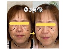 プレシャスワン 越谷店/美容鍼２００本