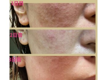 リボーン(REBORN)/肌改善Before&After