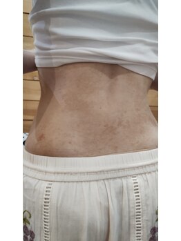 ハリス(HARIS)/皮膚　腹部　90％改善経過