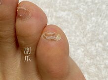 ニーヨンゼロ(240)/副爪