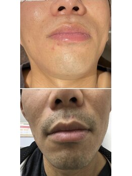 ホッコリ 段原店(HOKKORI)/人気No.1！ヒゲ脱毛♪