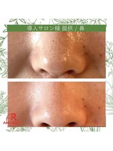 ラプリ 仙台店(Raplit stella)/ハーブピーリング/ニキビケア