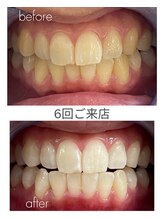 ホワイトニングショップ 福岡姪浜店/お客様before after