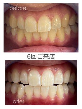 ホワイトニングショップ 福岡姪浜店/お客様before after