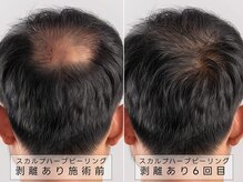 育肌美研 自由が丘サロン/頭皮ケア｜ハーブピーリング