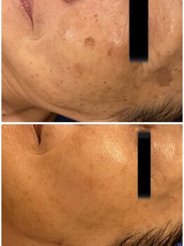 オンリーホープ(ONLY HOPE)/ダクトピール