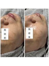 サラン スキンサロン(Sarang skin salon)/川西｜水光肌 韓国肌管理