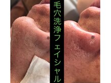 トータルビューティージュネス(TOTAL BEAUTY JEUNESSE)/毛穴洗浄FA　美肌パック付き♪