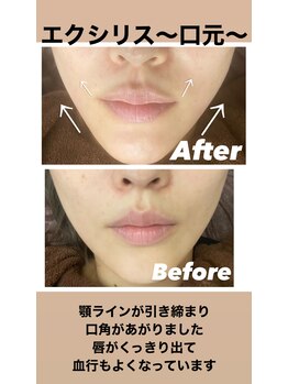 リベル(Liber)/痩身マシンエクシリス【口元】