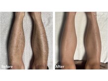 セラス(CERAS)/男性の足脱毛