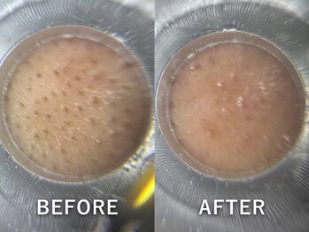 ドアディ(Doordie)/韓流毛穴洗浄スキンサクション