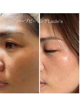 ラウレア/ハーブピーリング×小顔