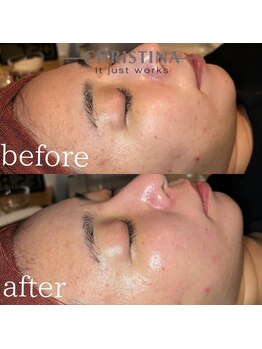 イデアル(Ideal)/人気のハーブピーリング