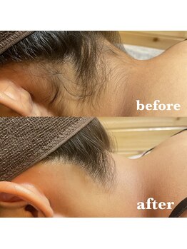 エクラーレ(ECLARE)/うなじのビフォーアフター