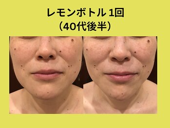 アユアランリンク 札幌店/レモンボトル/40代後半/1回