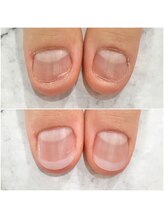 リファーレ(RIFARE)/【深爪矯正】初回長さ出し有