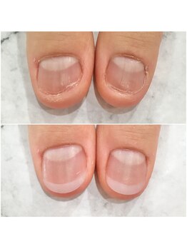 リファーレ(RIFARE)/【深爪矯正】初回長さ出し有