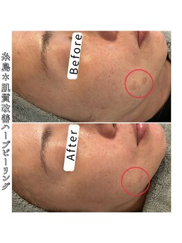 エヌプラス(N+)/40代女性＊ピーリング2回後(1)