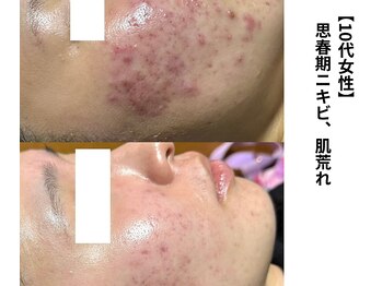 ボニータ(Bonita)/【Lit】ヒト羊膜幹細胞エステ2倍