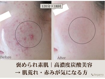 レガロビューティクリエイションズ桜川店/高濃度炭酸肌改善フェイシャル