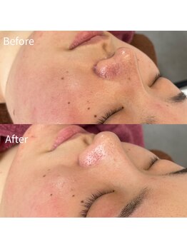 ビトタン 倉敷本店(+美to鍛)/ハーブピーリング1g/1回