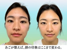 ナチュラルビューティーフェイス 横浜(NBF)/Before&After
