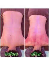 ビービー(BB)/ラジオ波＋バキューム【ボディ】